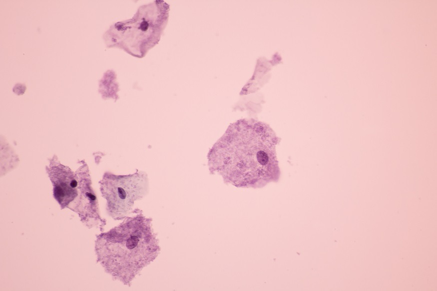 bacteriele vaginose